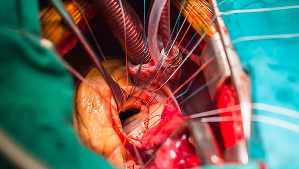 valve-replacement