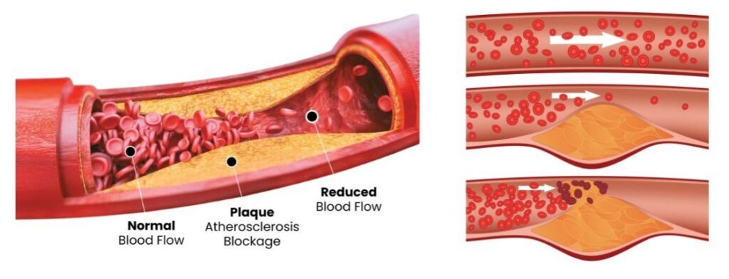 Vascular Screenings