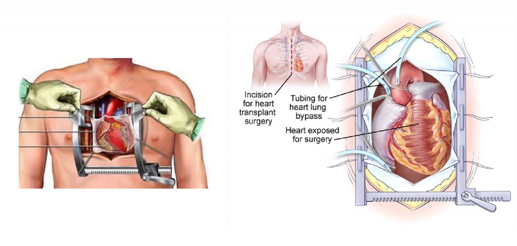 On-pump surgery (CPB)