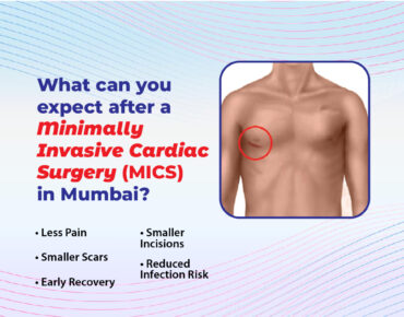 What Can You Expect After a Minimally Invasive Cardiac Surgery (MICS) in Mumbai