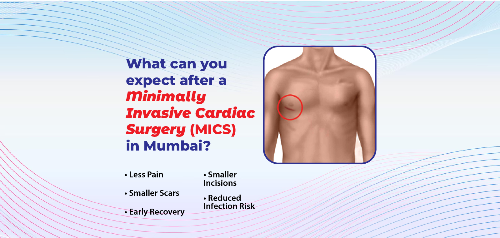 What Can You Expect After a Minimally Invasive Cardiac Surgery (MICS) in Mumbai