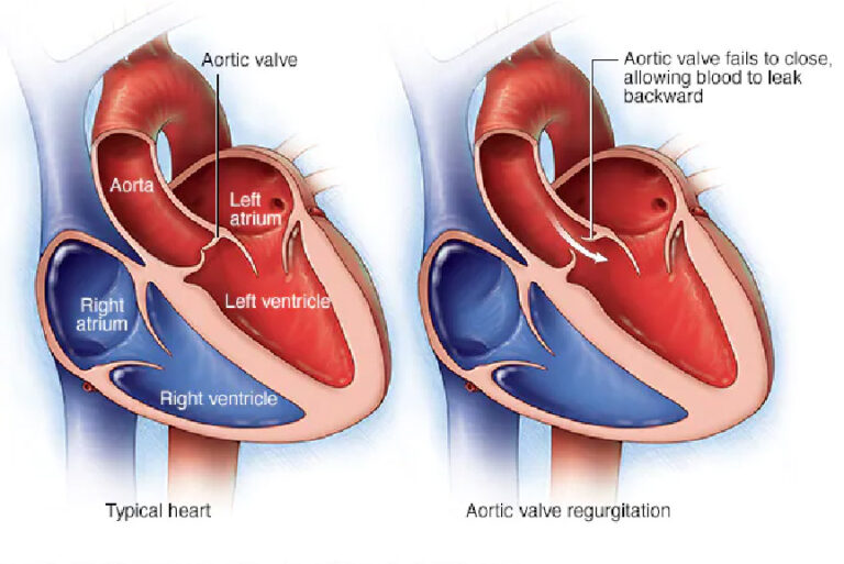 heart valves