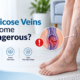 Can Varicose Veins Become Dangerous?